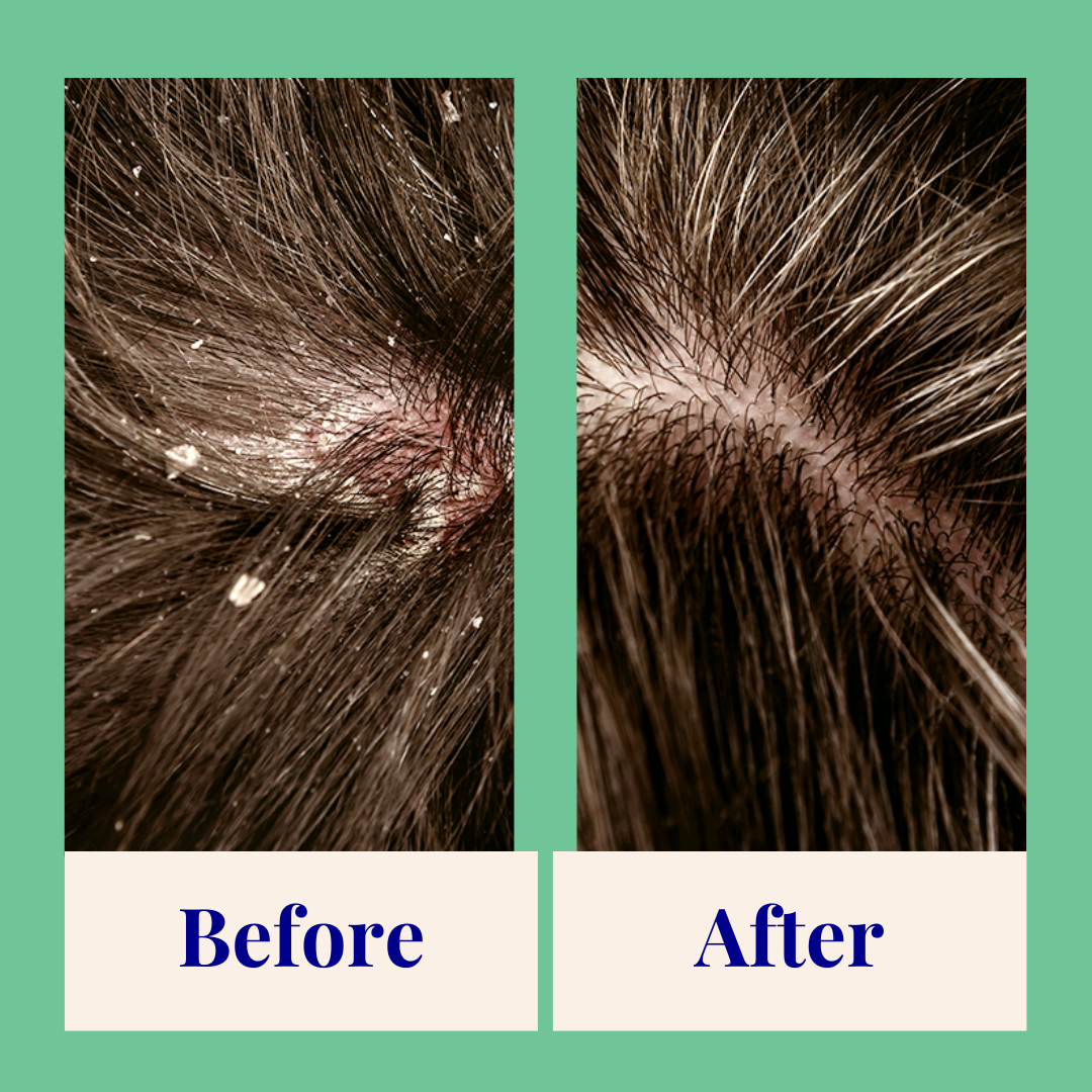 ThePowderShampoo_ExfoliatingPowderShampoo_TeaTree_Lifestyle3.png